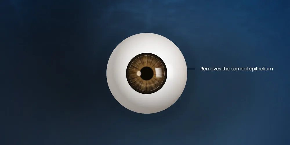 Diagram of the corneal surface layer removed in LASEK